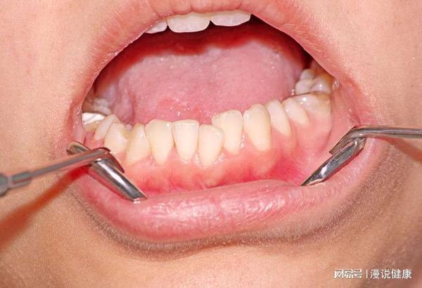 口腔問(wèn)題頻頻出現(xiàn)？別不當(dāng)回事，它的健康與全身健康息息相關(guān)！